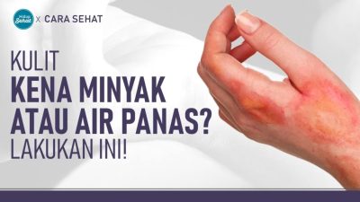 Mengapa Minyak Tawon Menimbulkan Sensasi Panas di Kulit? Penjelasan Medis dan Panduan Penggunaannya